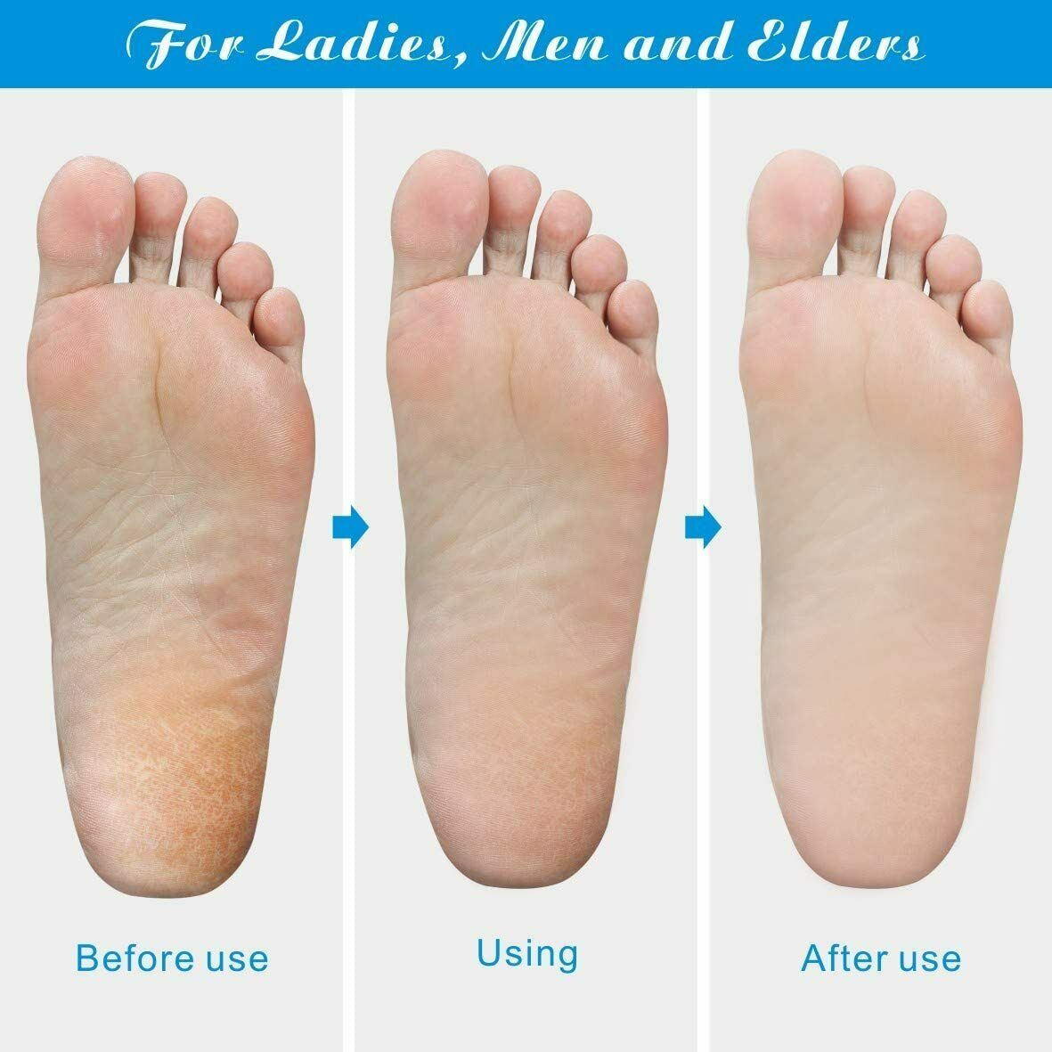 Professional Foot Callus Remover File